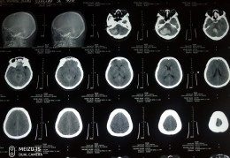 脑出血ct报告模板-脑出血ct报告单图片