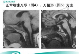 休门氏病影像PPT_布氏杆菌病症状和治疗